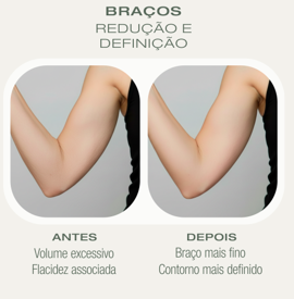 Antes e depois Crio — Braços