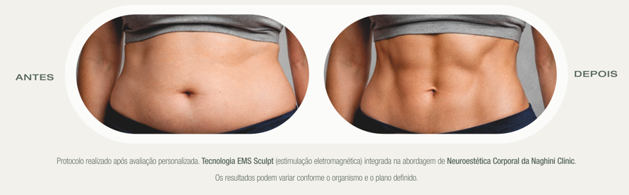 Antes e Depois do EMS Sculpt — Naghini Clinic