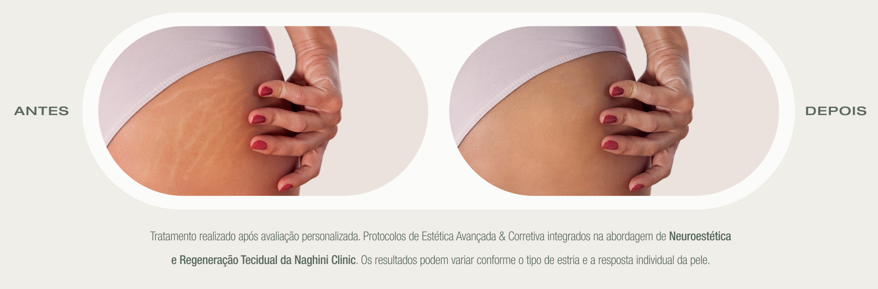 Antes e Depois do Tratamento de Estrias — Naghini Clinic Guimarães