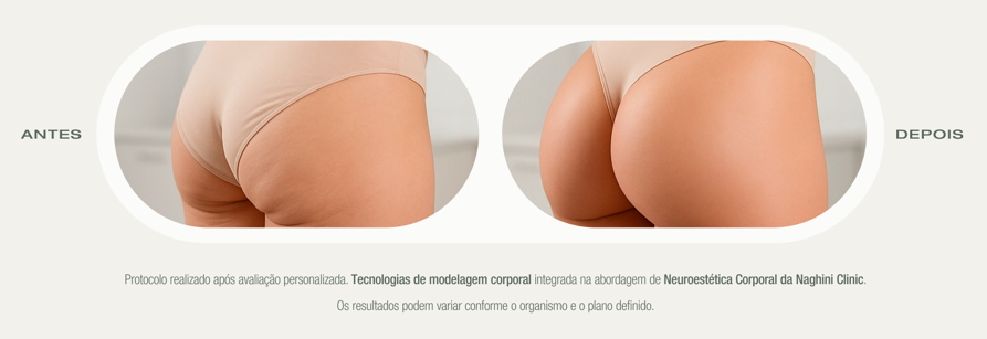 Antes e Depois — Aumento dos Glúteos & Harmonização Corporal — Naghini Clinic