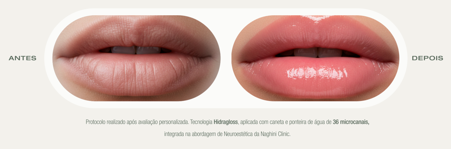 Antes e Depois do Protocolo Hidragloss — Naghini Clinic