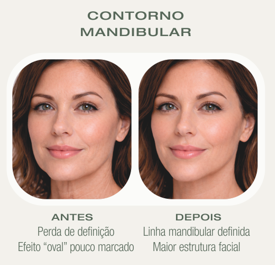 Antes e depois HIFU — Contorno Mandibular