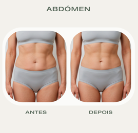 Antes e depois HIFU 22D Corporal abdómen