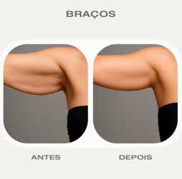 Antes e depois HIFU 22D Corporal braços