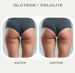 Antes e depois HIFU 22D Corporal glúteos