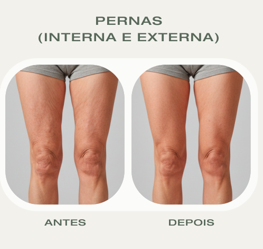 Antes e depois HIFU 22D Corporal pernas
