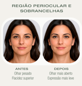 Antes e depois HIFU — Região Periocular e Sobrancelhas