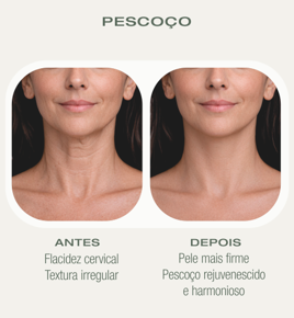 Antes e depois HIFU — Pescoço