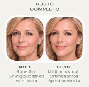 Antes e depois HIFU — Rosto Completo
