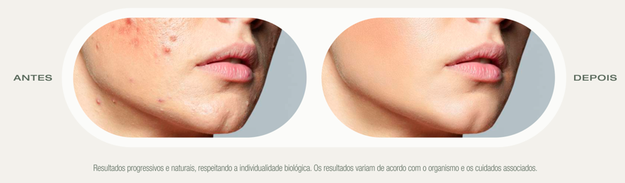 Antes e Depois do Protocolo Esmeralda — Naghini Clinic