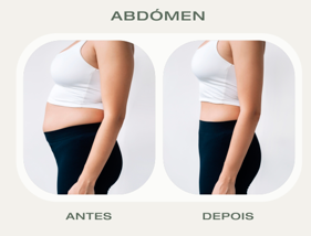 Antes e Depois Lipolaser Abdómen