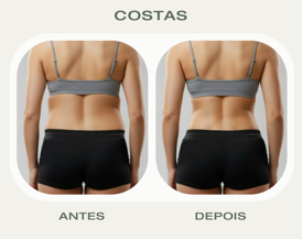 Antes e Depois Lipolaser Costas