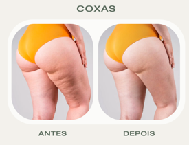 Antes e Depois Lipolaser Coxas