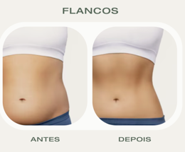 Antes e Depois Lipolaser Flancos