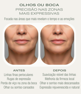 Olhos ou Boca — Antes e Depois Microagulhamento