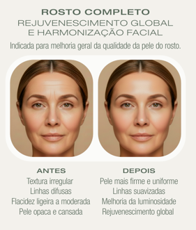 Rosto Completo — Antes e Depois Microagulhamento