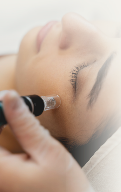 Microagulhamento Neuroskin Aveludado — Naghini Clinic Guimarães
