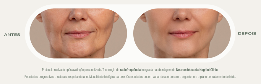 Antes e Depois — Protocolo de Rejuvenescimento Neuroestético com Radiofrequência — Naghini Clinic