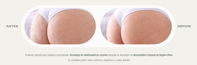 Antes e Depois — Radiofrequência Corporal na Naghini Clinic Guimarães