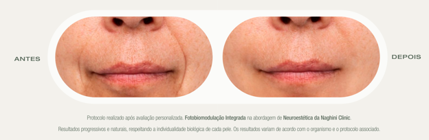 Antes e Depois — Protocolo de Reequilíbrio Neurocutâneo na Naghini Clinic