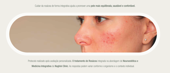 Tratamento de Rosácea — Naghini Clinic Guimarães