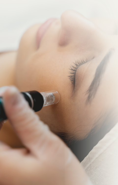 Microagulhamento Neuroskin Aveludado Guimarães — Naghini Clinic